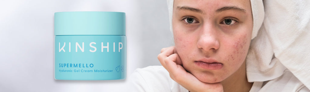 How To Treat Dehydrated Oily Skin: A Quick Skincare Guide