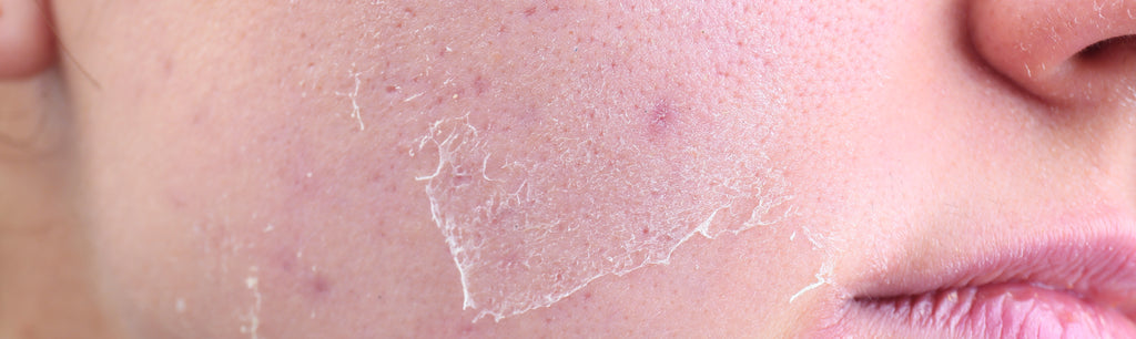 Can Dry Skin Cause Redness?