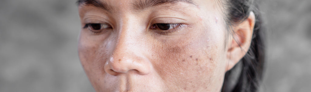 Does Hyperpigmentation Go Away?