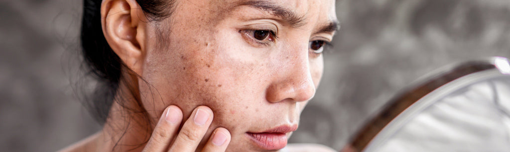 How to Get Rid of Dark Spots on Face