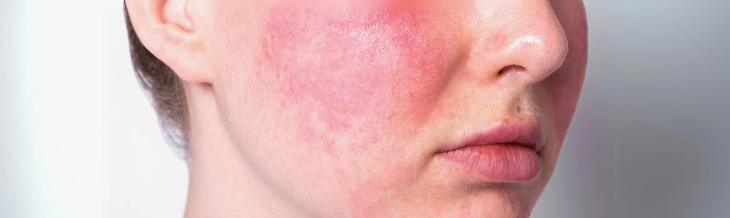 How to Reduce Skin Inflammation and Redness